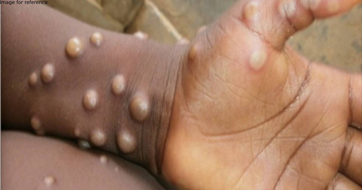 Centre to hold high-level review meeting on Monkeypox today